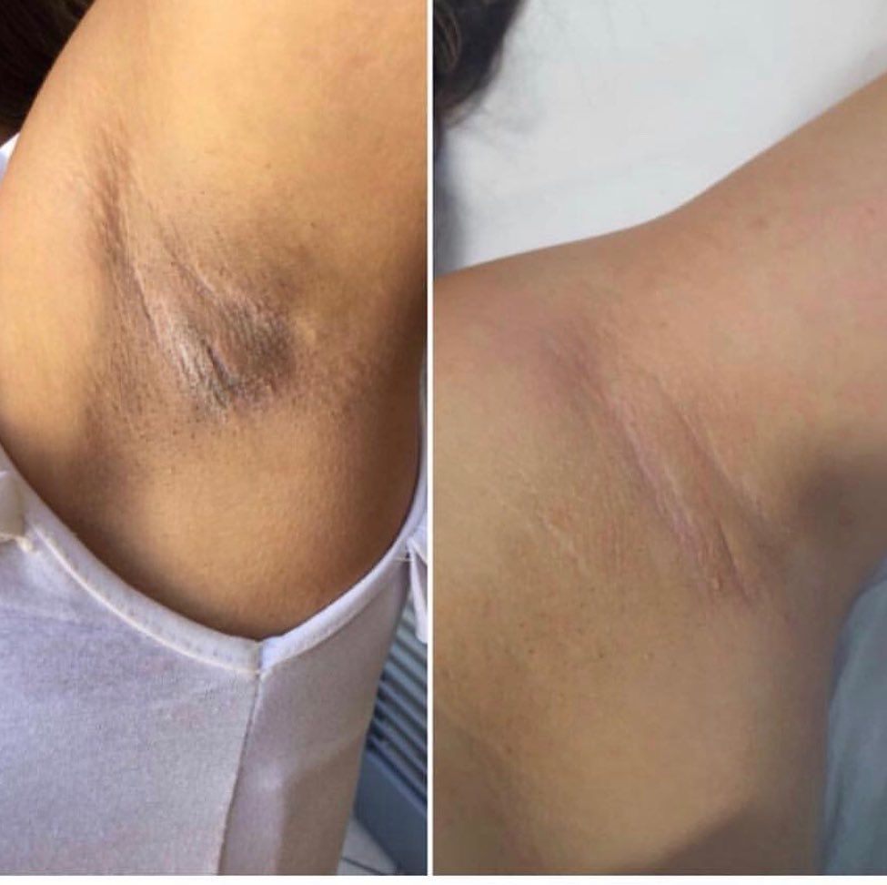 Depiladora Láser IPL Kit Completo — Eliminación de Vello en Casa
