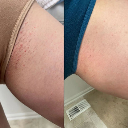 Depiladora Láser IPL Kit Completo — Eliminación de Vello en Casa